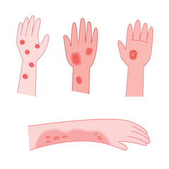 Fototapeta premium Red rash and itchy on hand cartoon for illustration and medical. Allergy concept