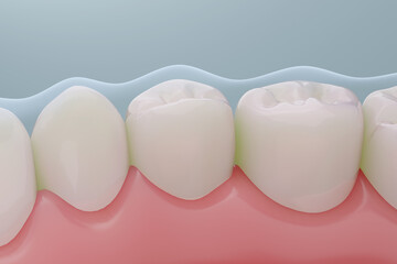 Tooth Protected by Fluoride and Enamel Coating