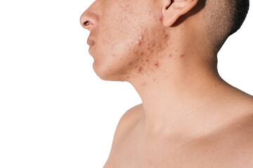 Cystic and hormonal acne on a man's face