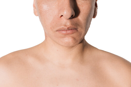Facial asymmetry in a man, deviation of the mandible with a white background