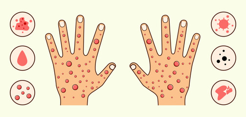Illustration of Two Hands with Red Spots and There are Explanatory Circles on the Right and Left Sides of the Hands