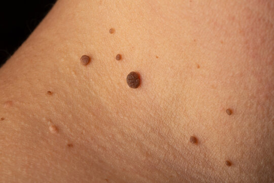 Multiple melanocytic nevi showing different sizes and shapes on skin surface