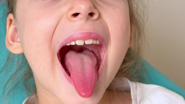 Close-up of little girl opening her mouth wide to the doctor to show her throat. Child is sitting with wide open mouth, with a tongue stuck out, clear view on the uvula and the soft palate
