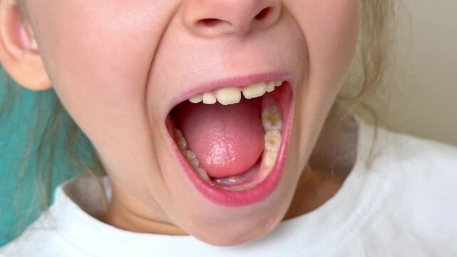 Little girl sitting in dentist chair showing her teeth to doctor. Baby teeth concept. Beautiful smiling preschool girl lost baby tooth. Dental hygiene concept