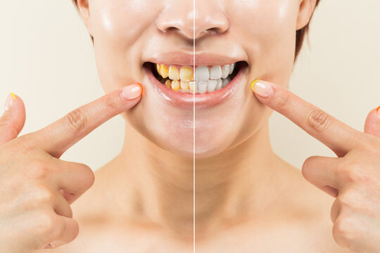 " ホワイトニングの効果 " 黄ばんだ歯と白い歯のクローズアップ相対比較.