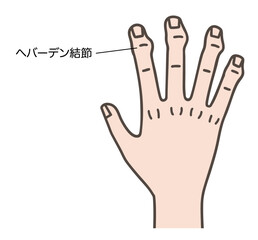 ヘバーデン結節で変形した手指