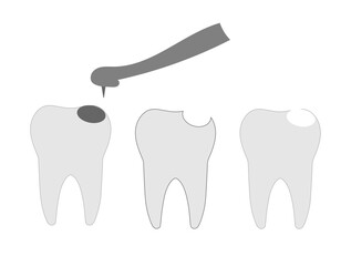 a set of three teeth with caries with a hole and a filling,