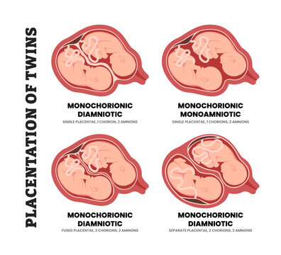 Different types of twin pregnancy or twin placentation types, educational medical poster design healthcare, monochorionic, diamniotic, monoamniotic, chorion, amnion and placenta. Dizygotic Monozygotic