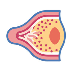 Illustrated artery cross-section with plaque buildup and thrombosis risk