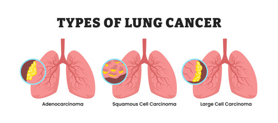 Different types of lung cancer types, educational medical poster design healthcare scheme, labeled adenocarcinoma, squamous cell carcinoma and large cell carcinoma. Respiratory system disease.