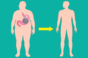 Weight loss concept with gastric balloon treatment illustrated on human body silhouette. eps 10
