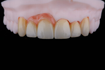 High-quality naturally dental single crowns made of zirconium for fixation to the frontal teeth of upper jaw.