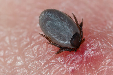 A tick that feeds on human skin. Blushing and redness. Details of the arachnid's body, hair, wrinkles on the surface, perfectly visible.