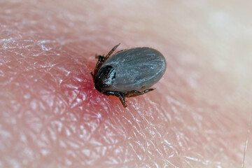 European castor bean tick, European sheep tick (Ixodes ricinus), tick in a skin.
