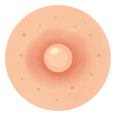 Types of Acne illustration 