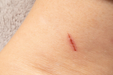 Close-up of fresh superficial wound healing on leg skin