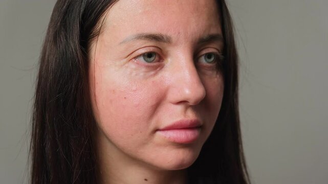 A close-up of a woman's face after biorevitalization, highlighting skin texture, hydration, and post-treatment redness.