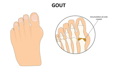 Fototapeta premium Gout foot disease vector illustration