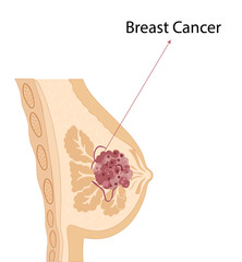 breast cancer