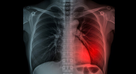 Chest X-Ray Highlighting Right Lung Pathology with Red Overlay
