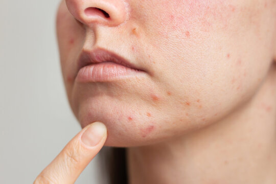 Young Caucasian woman examining the pimples on her chin close up. Girl is experiencing discomfort, suffering from a skin disease on her face-rosacea in the acute stage.	