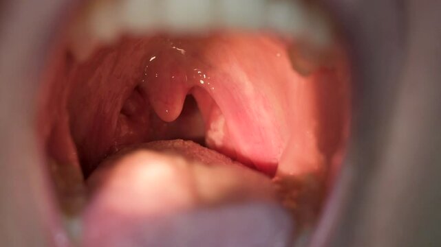 Close-up view of a human throat with tonsillitis, showing inflamed uvula and pus-filled tonsils caused by a bacterial infection