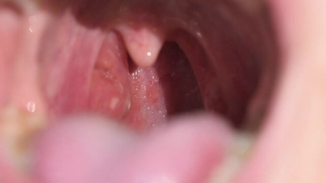 Close-up of swollen tonsils and uvula with pus, showing symptoms of tonsillitis