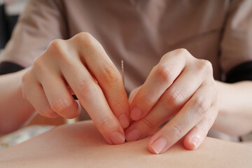 鍼灸院で背中に鍼治療をする女性