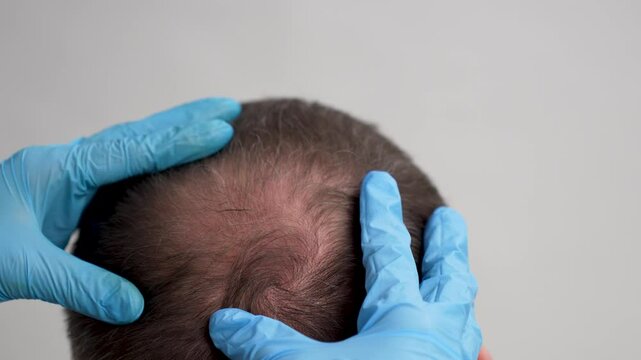 Doctor Examining Patient's Scalp for Hair Loss