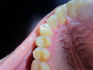 Close-up view of upper teeth showing multiple dental fillings and gum details.