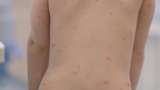A Back View of a Child Displaying Skin Rash chickenpox in a Medical Setting for Examination