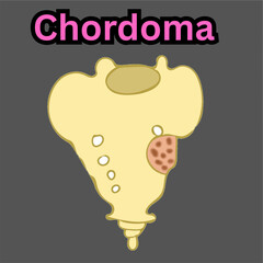 chordoma  bone tumor in notochord illustration useful for educational and healthcare industries orthopedics