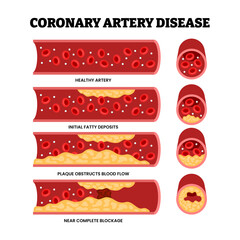 Different types of coronary artery disease types as a chest heart problem, educational medical poster design healthcare scheme, labeled initial fatty deposits, plaque obstruction blood flow blockage.