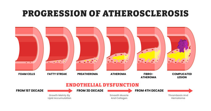 Stages of Progression atherosclerosis stage endothelial dysfunction development to vein complicated lesion, educational medical poster design healthcare scheme, labeled thrombosis formation