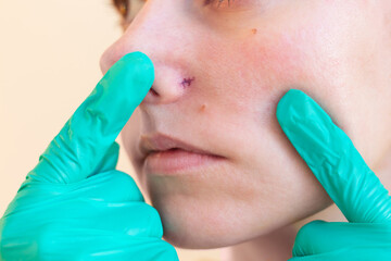 Close-up doctor in green gloves showing blood vessels after laser removal on the nose of a young woman suffering from couperose and rosacea.