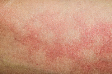 Human skin background texture dermatitis rash