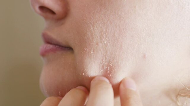Close up capturing woman gently touching dry, irritated facial skin, highlighting sensitive dermatological skincare texture and complexion issue