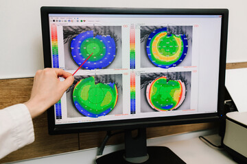 Ophthalmologist is showing corneal topography scan to girl patient near slit lamp. Diagnosis of the...