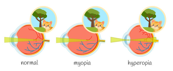 Vector medical illustration of vision impairment. Eye diseases myopia, hyperopia.
