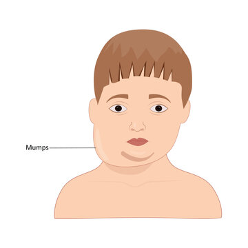 Mumps vector illustration