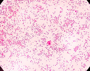 Neisseria gonorrhoeae is a species of Gram-negative diplococci bacteria. It causes the sexually transmitted genitourinary infection gonorrhea