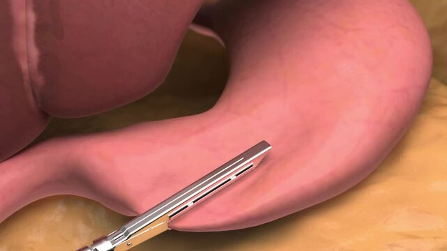 Sleeve gastrectomy, weight loss, slimming, horizontal screen, 3D animation rendering