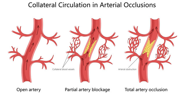 blood flow changes in artery from open flow to partial blockage and total occlusion, highlighting collateral circulation diagram hand drawn schematic vector illustration. Medical science educational