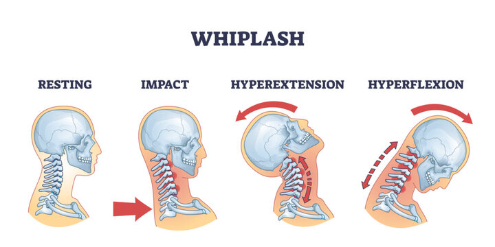 Whiplash diagram shows neck movement stages, resting, impact, hyperextension, hyperflexion, transparent background.