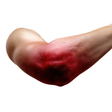 Bloodied Elbow Close-Up: An Exploration of Injury