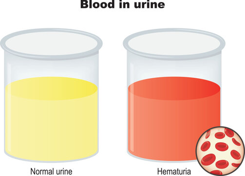 two beakers with urine. Normal and bloody urine. Hematuria is the presence of red blood cells in the urine (causing the red color). Vector diagram of red blood cells

