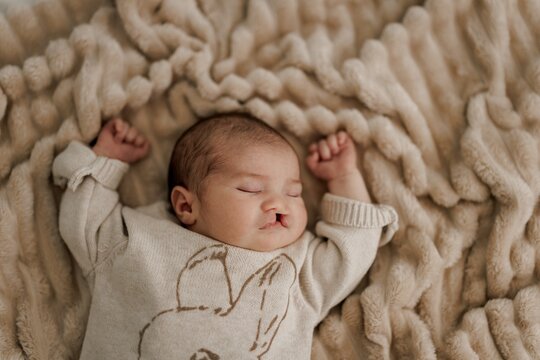 A sleeping newborn baby with congenital defect of cleft lip and palate wrapped in a cozy blanket, resting peacefully in a crib. The baby has a serene expression