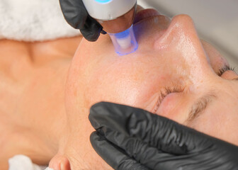 Close-up portrait of a beautiful aged woman during microneedling with dermapen from a beautician.