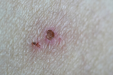 Macro of skin with crust,  Inflamed mosquito bite wound
