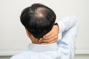 Fototapeta premium Bald in the middle head and begin no loss hair glabrous of mature Asian business smart active office man.